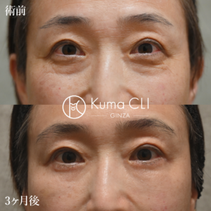 表ミッドフェイスリフト法＋ナノリッチ＋おでこの脂肪注入